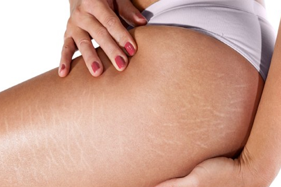 Traiter les vergetures